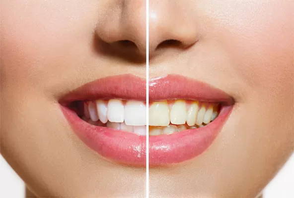 teeth whitening before and after